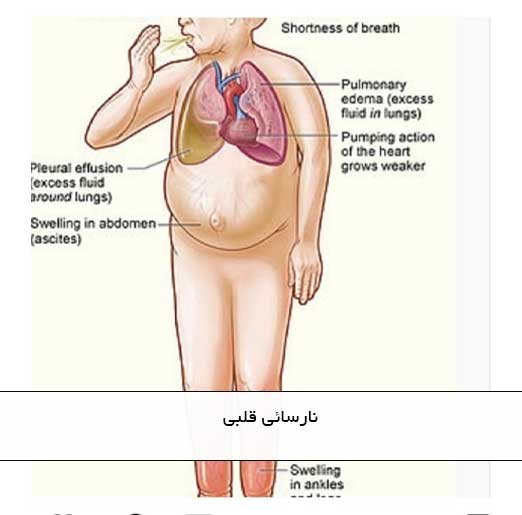 نارسائی قلبی