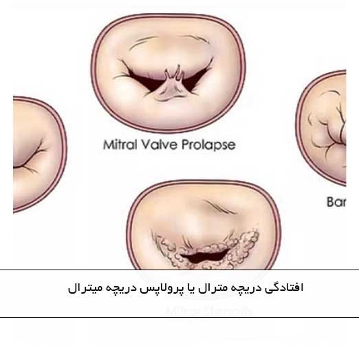 افتادگی دریچه مترال یا پرولاپس دریچه میترال